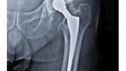 hip replacement x-ray