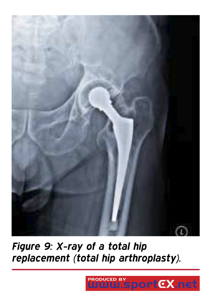 5 Ways to Help Ease Your Hip Joint Pain