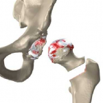 How to Avoid Common Joint Injuries