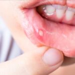 How Canker Sores Happen And Ways To Treat Them