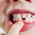 Your Complete Guide to Overbite: Causes, Health Risks, & Treatments