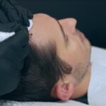 Scalp Micropigmentation: Preparation And Aftercare