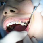 The Truth about Wisdom Teeth Removal