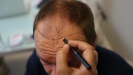 receding hair
