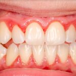 4 Causes And 3 Treatment Options For Swollen Gums