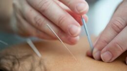 acupuncture