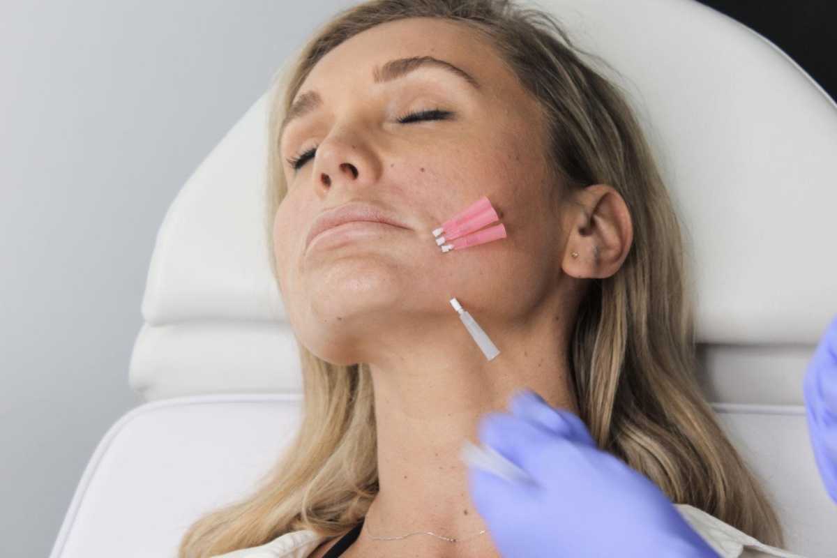 Mono Threads: A Non-Surgical Method For Skin Rejuvenation