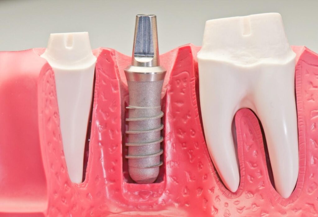 dental orthodontic implant