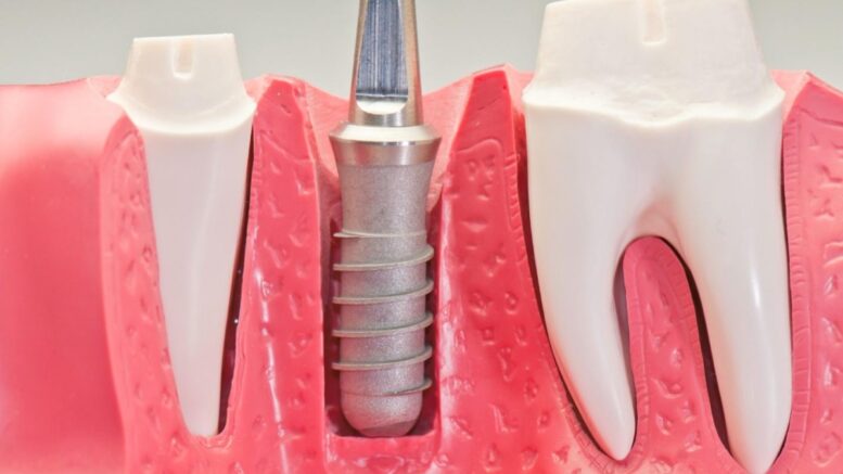 dental orthodontic implant