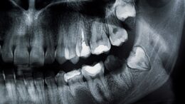dental xray