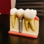 Dentures vs. Implants: Which One’s The Best?