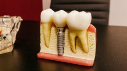 dental implant anatomy