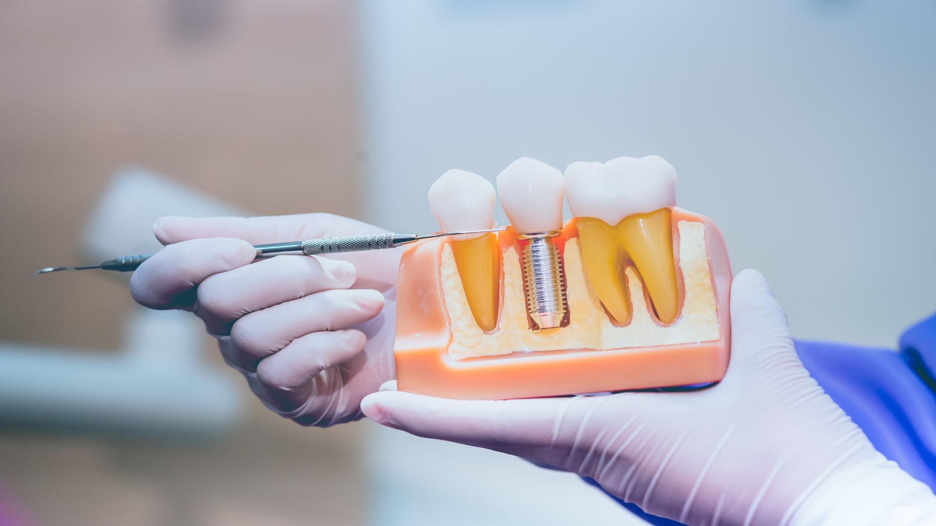 dental implants new