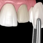 Dental Crown vs. Veneer: Which Is Right For Your Teeth?