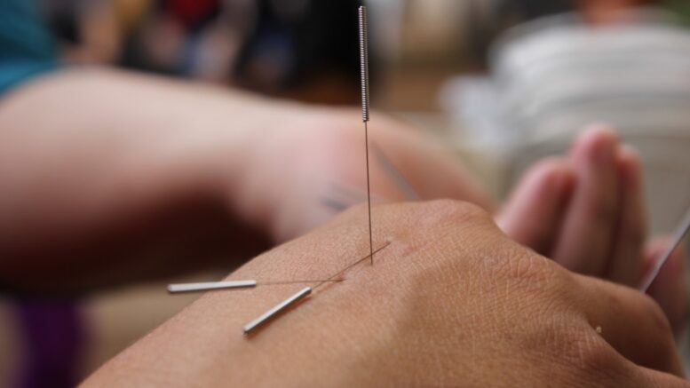 Acupuncture hand