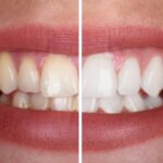 Tooth Discoloration: Causes, Treatment, & Prevention