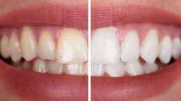 teeth whitening