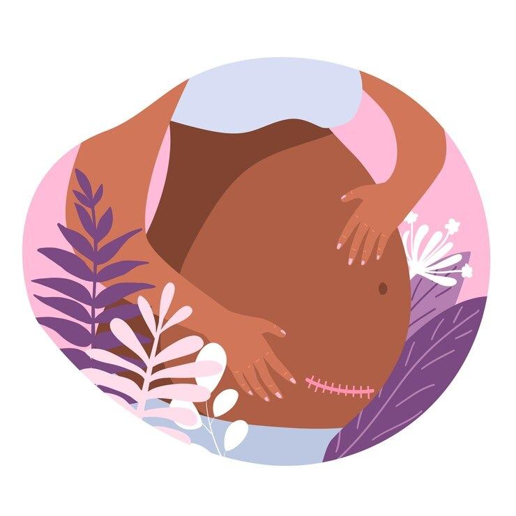 Everything You Need To Know About C-sections