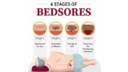 bedsores