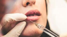 lip filler botox