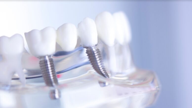 periodontal implants