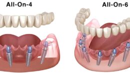 All-on-4 and All-on-6 Dental Implants