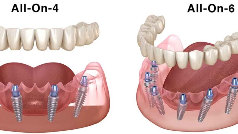 All-on-4 and All-on-6 Dental Implants